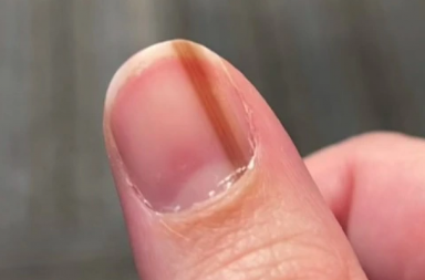 10 godina sam mislila da je linija na mom noktu običan beleg: Iza svega se krila jeziva istina, jedan doktor mi je spasio život