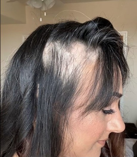 Žena je bila očajna, jer je maltene oćelavila: Promenila je ishranu i kosa je izrasla ponovo za 2 meseca!