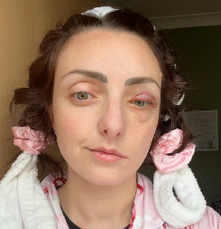 "Smrtonosna bolest unakazila mi je lice": Titranje oka bilo je opasno upozorenje koje je ona uporno ignorisala