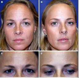 Briše bore bolje od botoksa: Napravite savršenu masku za lice i prirodnim putem zategnite kožu