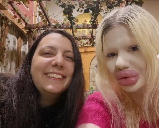 Bugarka sa NAJVEĆIM USNAMA na svetu otkriva zašto NE MOŽE da stane: Pogledajte kako je Andrea Ivanova nekada izgledala pre estetskih operacija