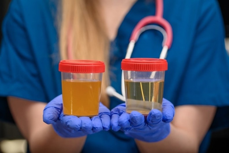 Da li je taman urin opasan? Evo šta ova boja mokraće govori o vašem zdravlju