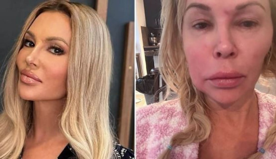 Bivša rijaliti zvezda preživljava horor: Parazit joj razjeda lice, pokušala da ga ‘spali’ kremom za depilaciju