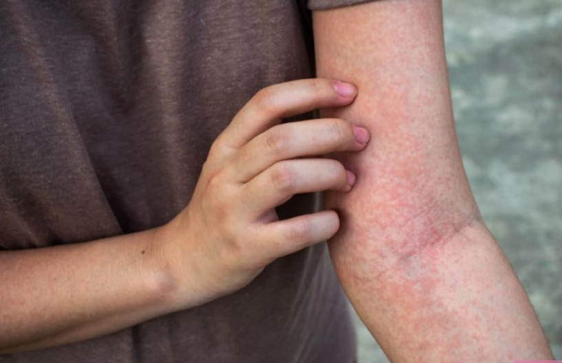 Julijani se pojavio osip i mislila je da je bezazlen: U roku od 15 minuta bila je na ivici smrti, lekari su je jedva spasli