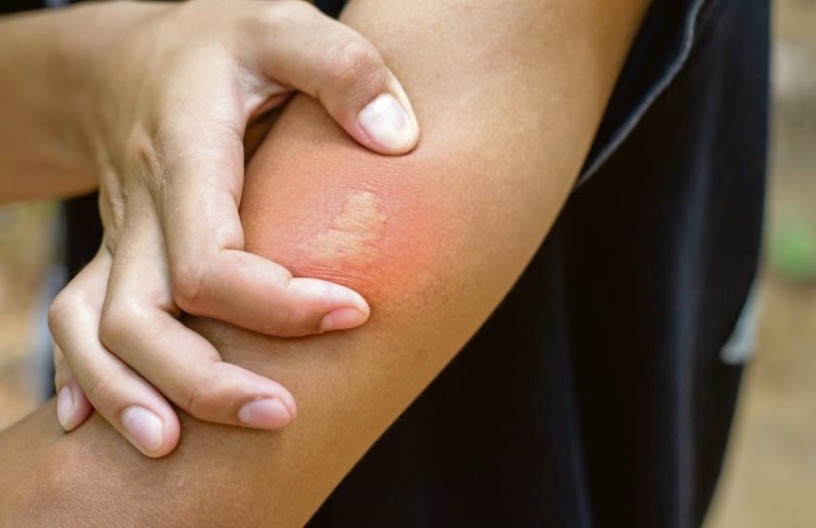 Jedini spas kod uboda ose, pčele ili stršljena: Ovaj trik će odmah ukloniti bol i otok