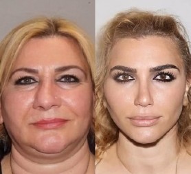 Turci su ovim zahvatom prelazišli sami sebe: Sredovečnu ženu pretvorili u devojku, "komotno bi mogla da bude nova Hurem"