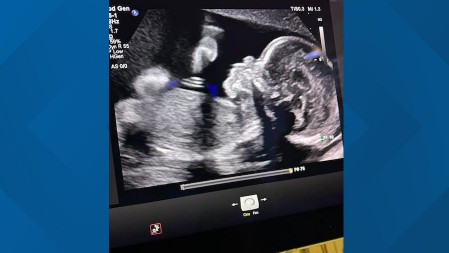 Porodica u agoniji: Žena moždano mrtva tri meseca, ali trudnoća mora da se nastavi