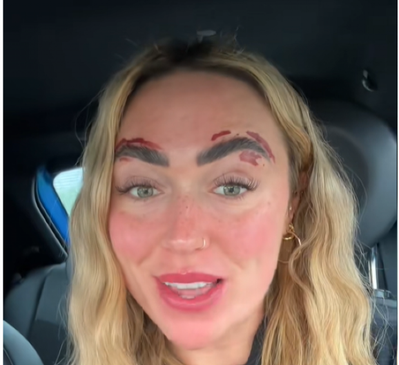 Martina proklinje dan kad je otišla na depilaciju obrva: "Spalila mi je lice, već danima ne mogu da dođem sebi!"